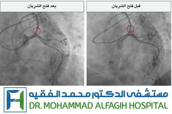 كفاءة تتخطى التحديات! ... مستشفى الدكتور محمد الفقيه ينقذ حياة في سباق مع الزمن!