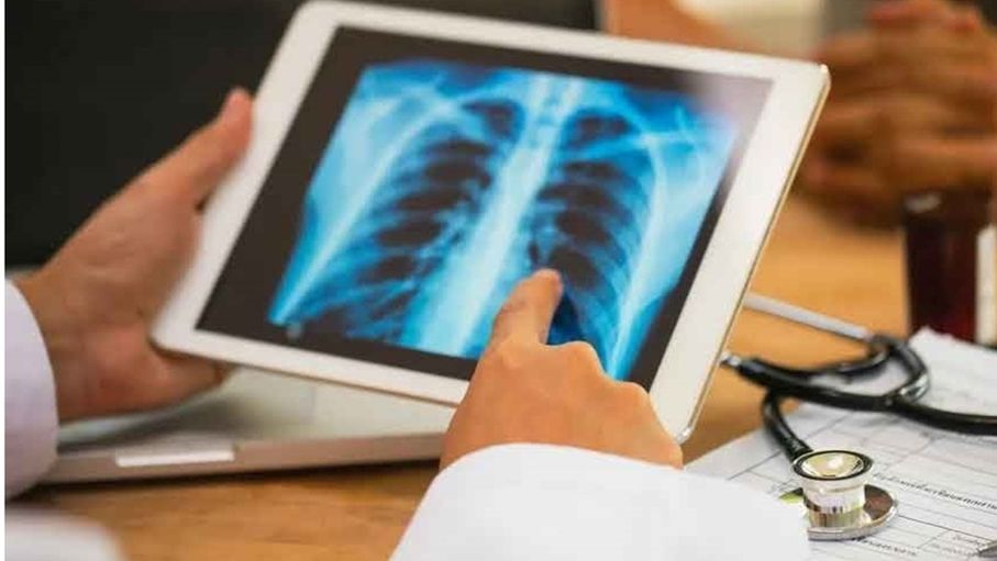 تحول طبي لافت.. جراحات سرطان الرئة ممكنة لمن هم فوق الثمانين