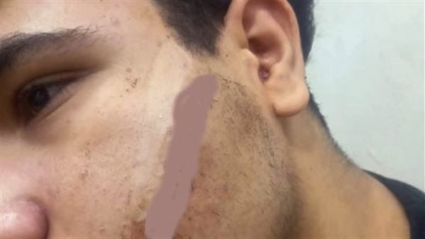 إصابة طالب في مشاجرة عقب الامتحان بشبرا الخيمة ومديرية التعليم تفتح تحقيقًا موسعًا