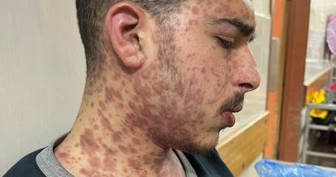 مرض نادر وإمكانيات غائبة.. محمد ضبان على ـأعتاب الموت فى مستشفيات غزة