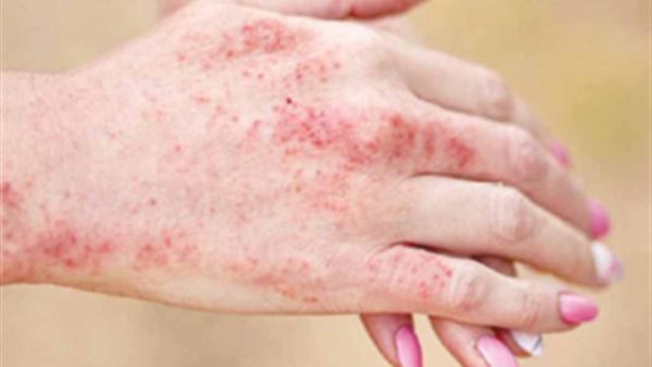 طفح الوجه الأحمر في الصيف.. قد يكون علامة مبكرة لمرض الذئبة لا يجب تجاهلها