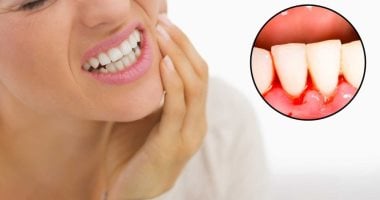 علامات اللثة السليمة وإشارات غير صحية انتبه لها