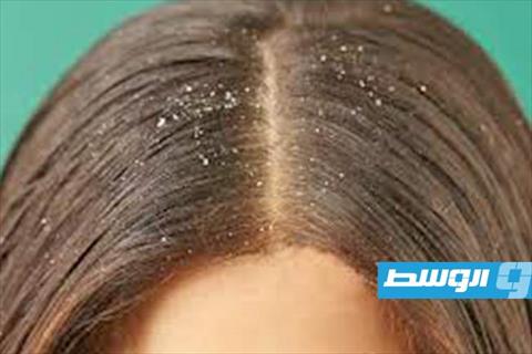 تخلصي من القشرة بمكونين فقط من مطبخك