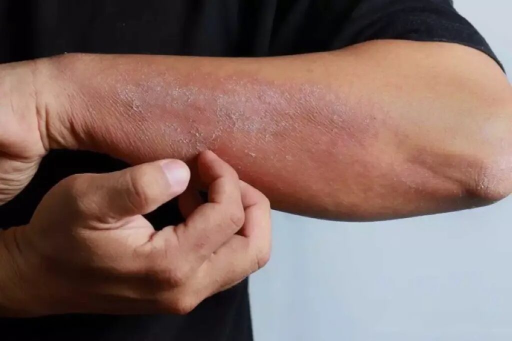 ابتكار بروتوكول غذائي لمعالجة الإكزيما… خلال 30 يوماً