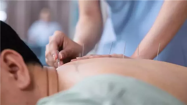 وهم أم بديل آمن؟ دراسة تكشف دور الوخز بالإبر في تسكين الآلام الحادة والمزمنة