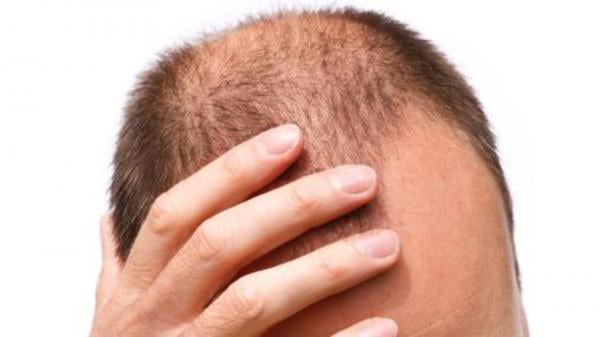 قبعة علاج ضوئي مرنة قد تفتح آفاقاً جديدة لعلاج تساقط الشعر