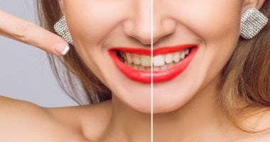 طرق طبيعية بسيطة للتخلص من اصفرار الأسنان