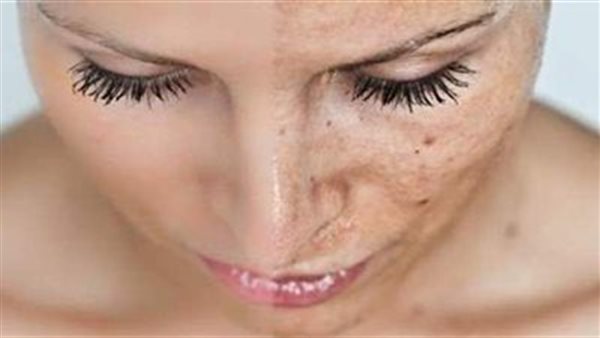 نصائح مهمة تجنبك ظهور الكلف بالبشرة