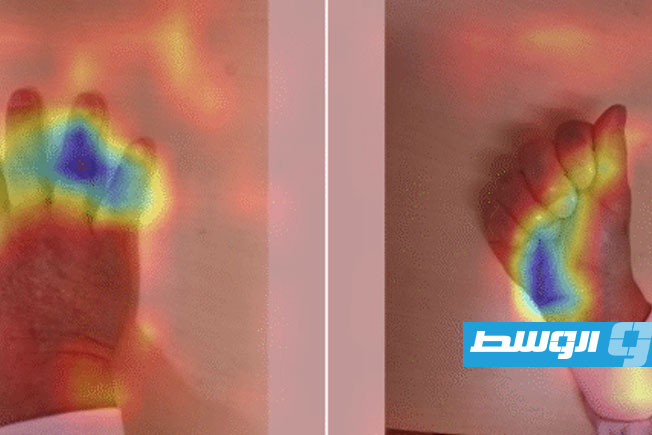 صورة لظهر اليد تكشف مبكرًا مرض تضخم الأطراف بمساعدة الذكاء الصناعي