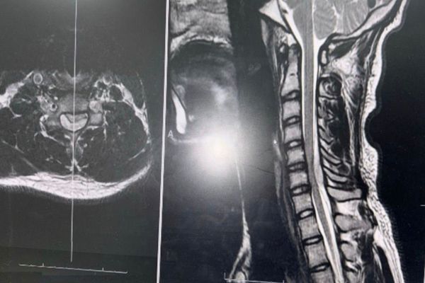 فريق طبي بعسير- ينقذ عشريني من شلل الأطراف