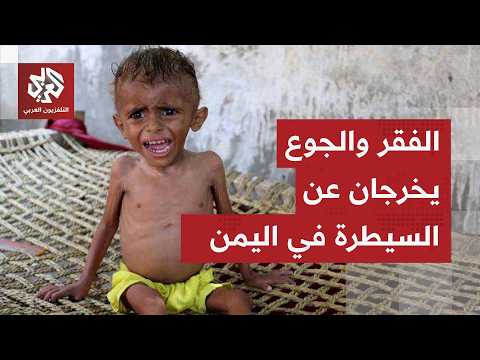 سوء التغذية يجتاح 15 محافظة يمنية والبنك الدولي يتخذ قرارًا عاجلاً لإنقاذ ما يمكن إنقاذه
