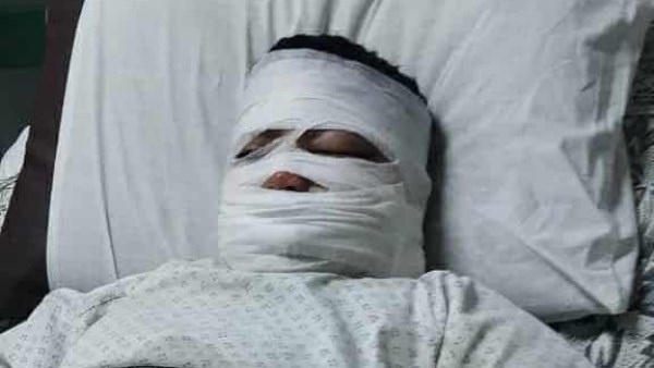 كان رايح يشتري سحور .. إصابة طفل بحروق إثر سقوط طاسة زيت مغلي عليه في بنها