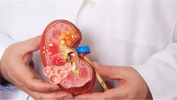 عميد معهد الكلى: العرقسوس في رمضان يسبب ارتفاعا مفاجئا في ضغط الدم ويرهق الكلى (فيديو)