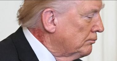 "بقعة حمراء" في رقبة دونالد ترامب تثير التكهنات