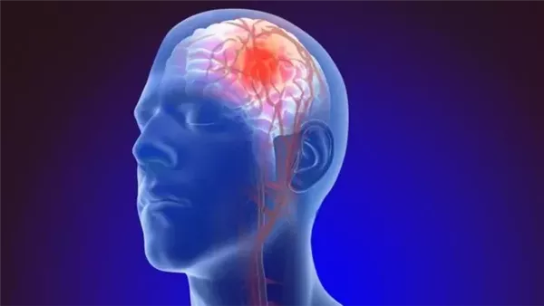 الصحة: جلطة المخ تبدأ بأعراض مفاجئة واحذر تجاهل هذه العلامات
