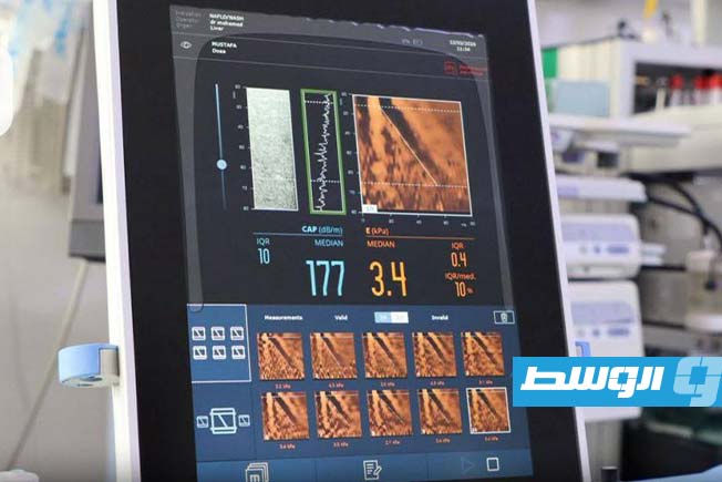 جهاز يفحص الكبد دون تدخل جراحي يدخل الخدمة بمستشفى الهضبة الخضراء