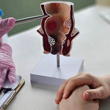 البواسير.. متى يصبح التدخل الجراحي ضرورة؟