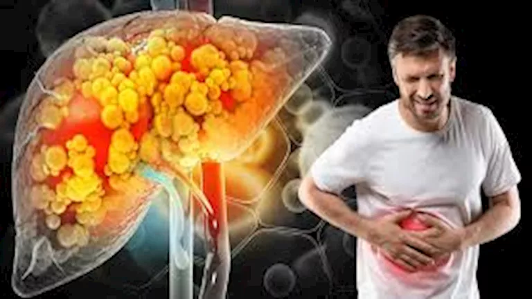 مرض الكبد الدهني.. ما مخاطره وكيف يمكن الوقاية منه؟