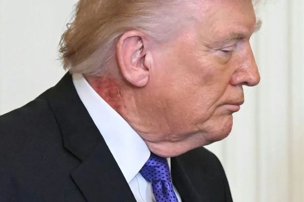 ترمب يظهر بطفح جلدي أحمر على رقبته