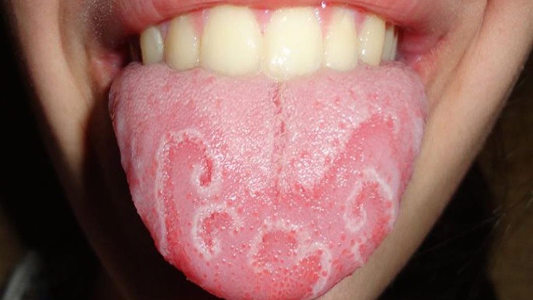 عرض في لسانك قد يكون أول إنذار لمرض خطير