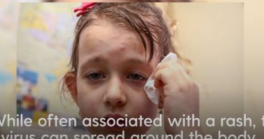 كيف تنتشر الحصبة وما أعراضها وهل يمكن أن تسبب مضاعفات خطيرة؟