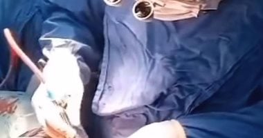 ملحمة طبية بغرفة العمليات.. جراحو قصر العيني ينقذون طفلاً من "مسمار في القلب"