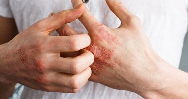 دراسة تكشف روابط بين الإكزيما واضطرابات النوم