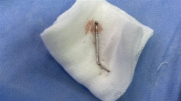 بعد تدخل طبي عاجل، استخراج مسمار من صدر شاب بطنطا