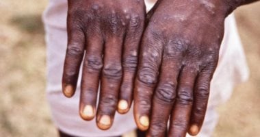 روسيا تعلن تسجيل إصابتين بجدرى القردة بين عائدين من الخارج