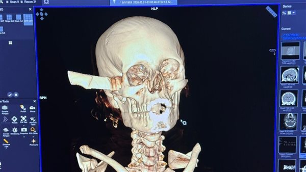 قصر العيني يكشف تفاصيل استخراج سكين من جمجمة مريضة