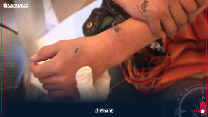 زيارة ميدانية لصبراتة لبحث مكافحة داء اللشمانيا والتخلص الآمن من المخلفات الطبية