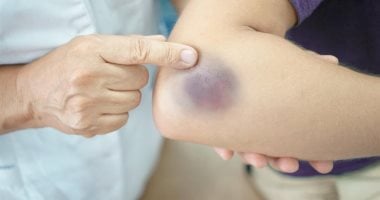 6 علاجات طبيعية منزلية لتسريع شفاء الكدمات