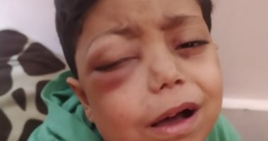 خالد عاشور طفل فلسطينى يواجه السرطان بعين تنزف ألما وحلم وحيد بالنجاة