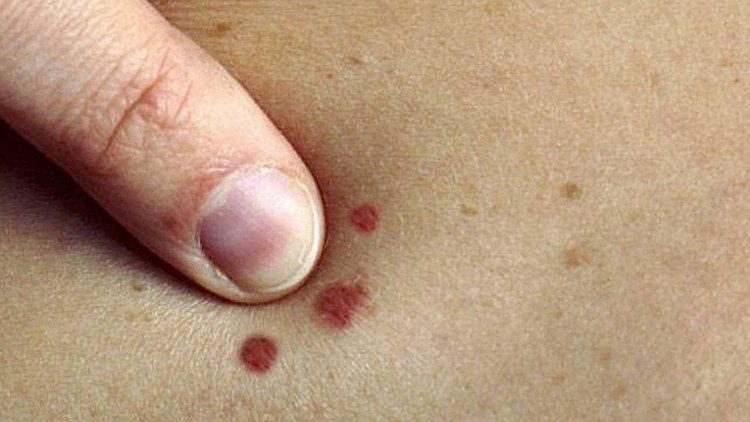علامات خطيرة على جلدك تكشف الإصابة بهذا المرض.. لا تتجاهلها قبل فوات الأوان