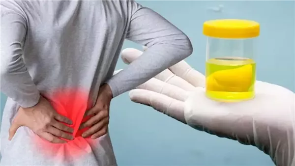 إهماله يسبب مضاعفات خطيرة، علاج زلال البول وأسباب الإصابة به