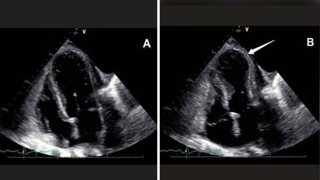 القلب يتأثر بالمشاعر: كيف يمكن للحب والحزن أن يؤثّرا فعليًا على صحة القلب؟