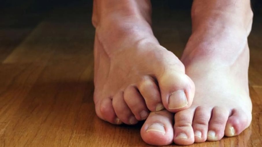 تململ الساقين.. جرس إنذار لمشاكل صحية أعمق